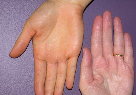 Nhìn tay bắt bệnh: 30 vấn đề sức khỏe sẽ thể hiện rõ qua vẻ ngoài của bàn tay - Ảnh 1.