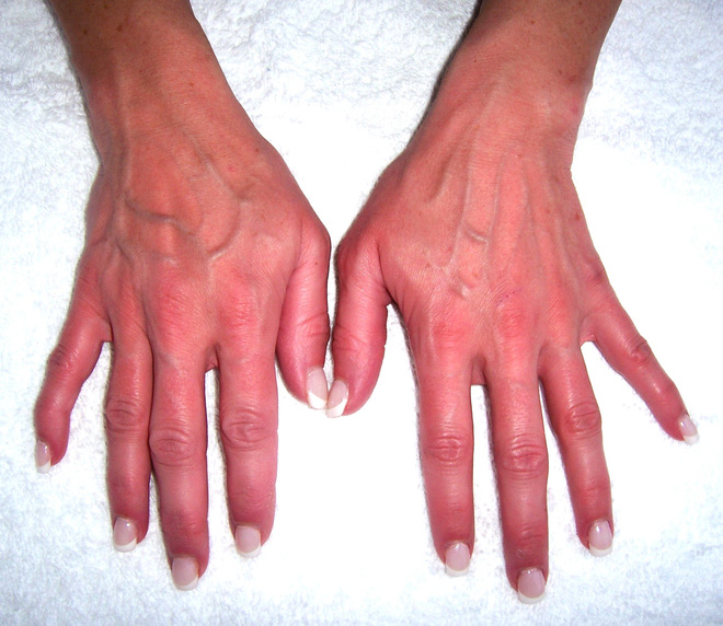Nhìn tay bắt bệnh: 30 vấn đề sức khỏe sẽ thể hiện rõ qua vẻ ngoài của bàn tay - Ảnh 2.