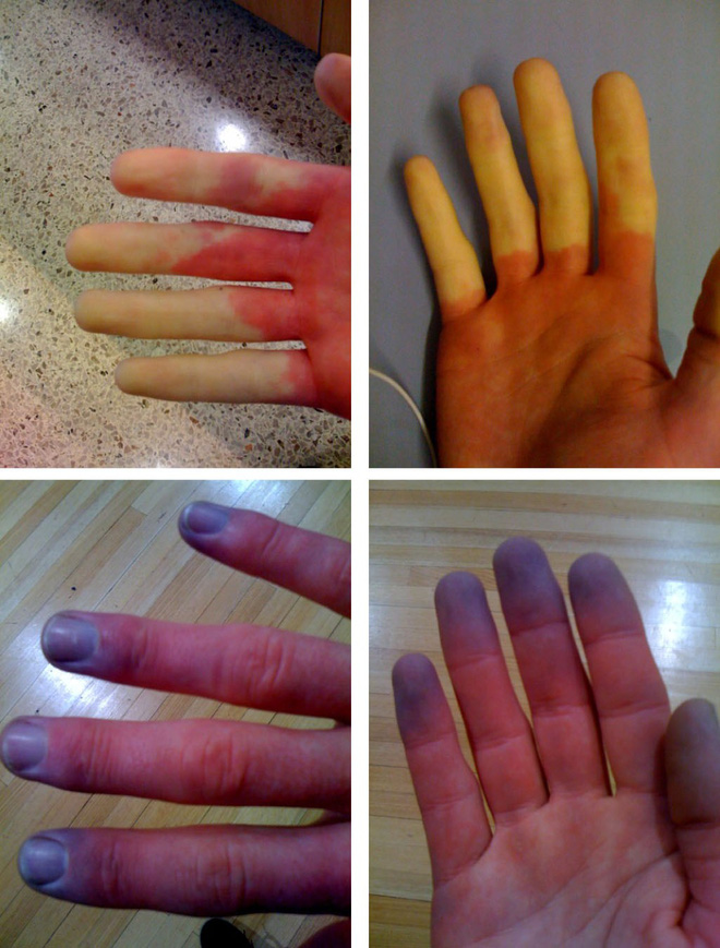 Nhìn tay bắt bệnh: 30 vấn đề sức khỏe sẽ thể hiện rõ qua vẻ ngoài của bàn tay - Ảnh 4.