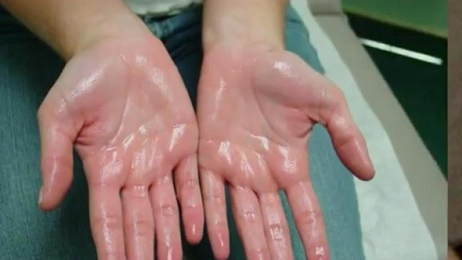 Nhìn tay bắt bệnh: 30 vấn đề sức khỏe sẽ thể hiện rõ qua vẻ ngoài của bàn tay - Ảnh 6.