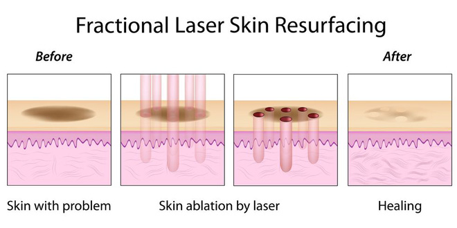 J-Plasma - Thêm một phương pháp làm trẻ hóa da thần kì hơn cả Botox và Laser - Ảnh 4.