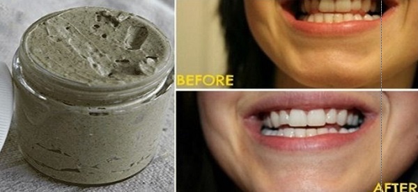 Tự chế kem đánh răng tự nhiên chữa sâu răng và làm trắng răng hiệu quả trong 1 nốt nhạc